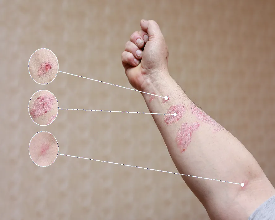 Sedef Hastalığı: Nedir, Nedenleri, Belirtileri, Tanı ve Tedavisi