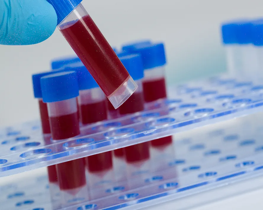 MCH: Ortalama Eritrosit Hemoglobin Değeri Hakkında Bilmeniz Gerekenler