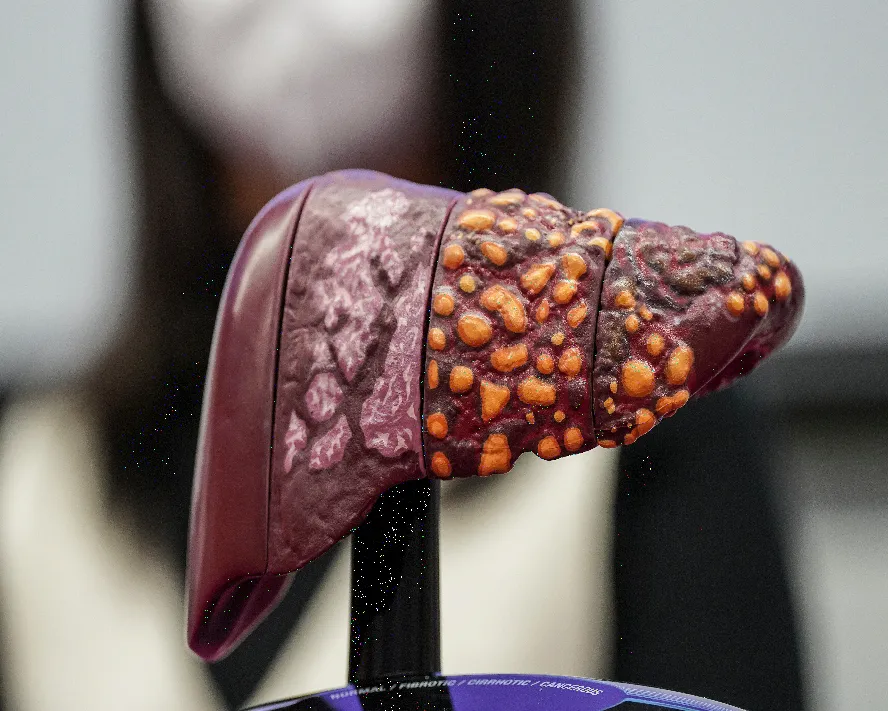 Karaciğer Kanseri Belirtileri: Ne Zaman Doktora Başvurmalısınız?