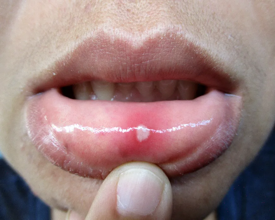 Aft Nasıl Geçer? Aft Nedenleri, Belirtileri ve Etkili Çözümler