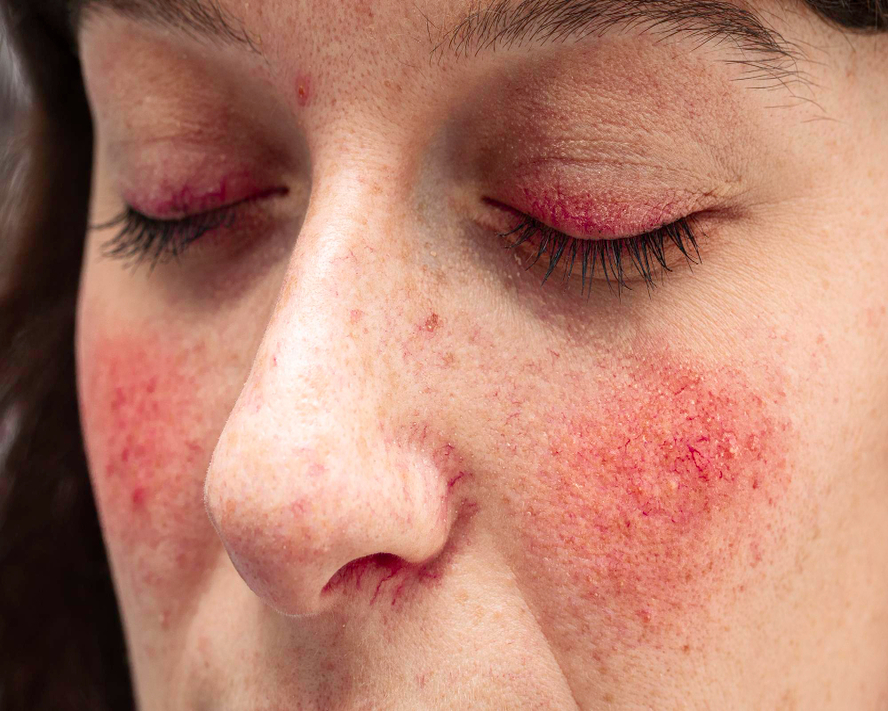 Lupus Hastalığı Nedir? Belirtileri ve Erken Tanı Yöntemleri