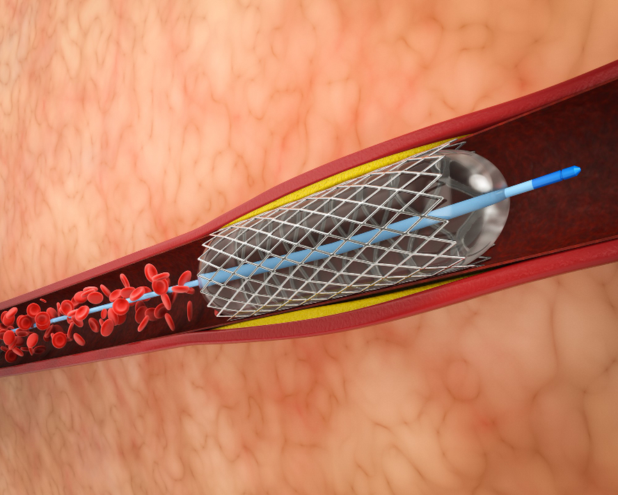 Stent Nedir? Kalp ve Damar Hastalıklarında Stent Uygulamaları Hakkında Bilmeniz Gerekenler