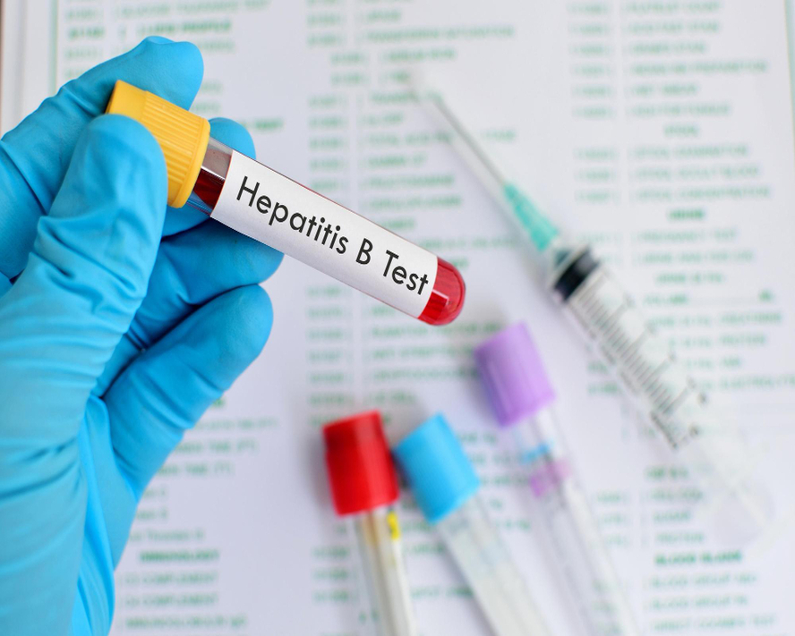 Hepatit B HBsAg Testi: Hayati Önemi ve Faydaları