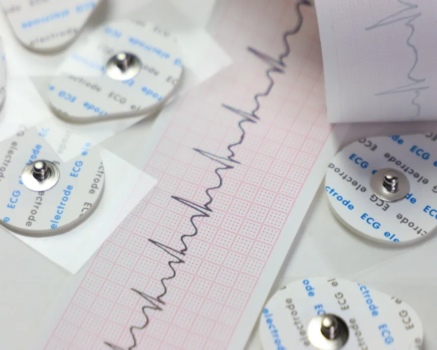 EKG (Elektrokardiyografi) Nedir? Kalbiniz Size Ne Anlatıyor?