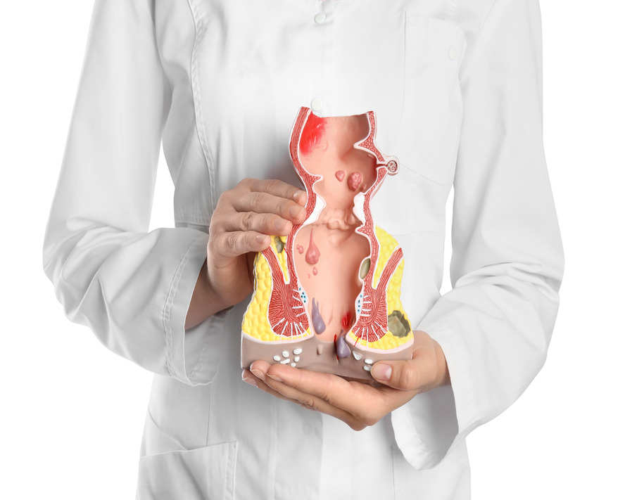 Anal fissür( Makat Çatlağı) Nedir? Belirtileri ve Tedavisi