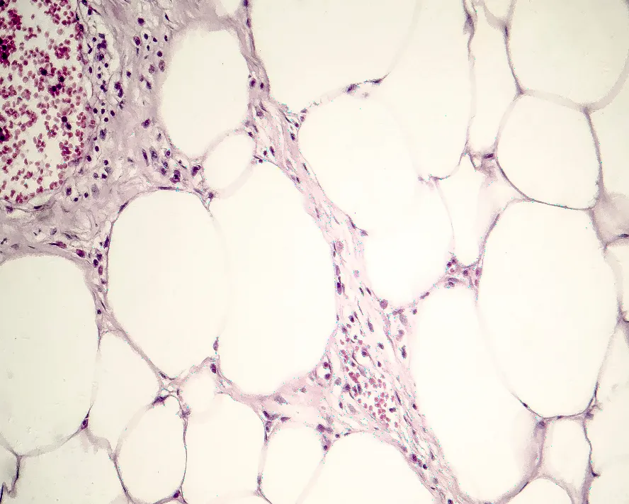 Yağ Bezesi (Lipoma) Nedir? Yağ Bezesi Nasıl Geçer?