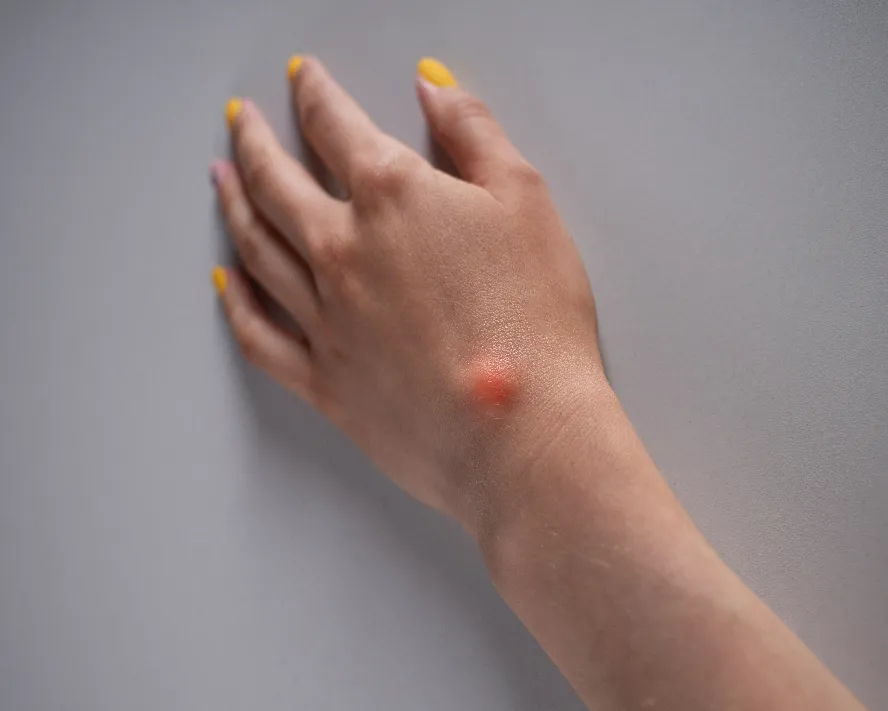 Ganglion Kisti: Nedenleri, Belirtileri ve Güncel Tedavileri