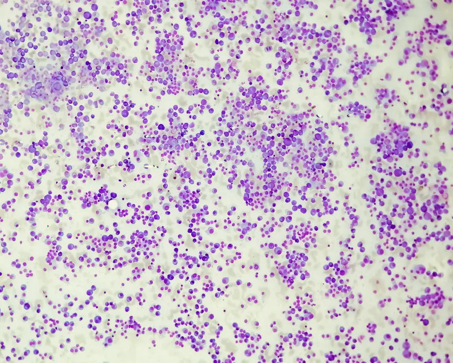Multipl Miyelom