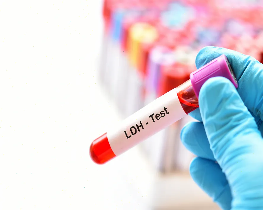 LDH Yüksekliği veya Düşüklüğü Ne Anlama Gelir?
