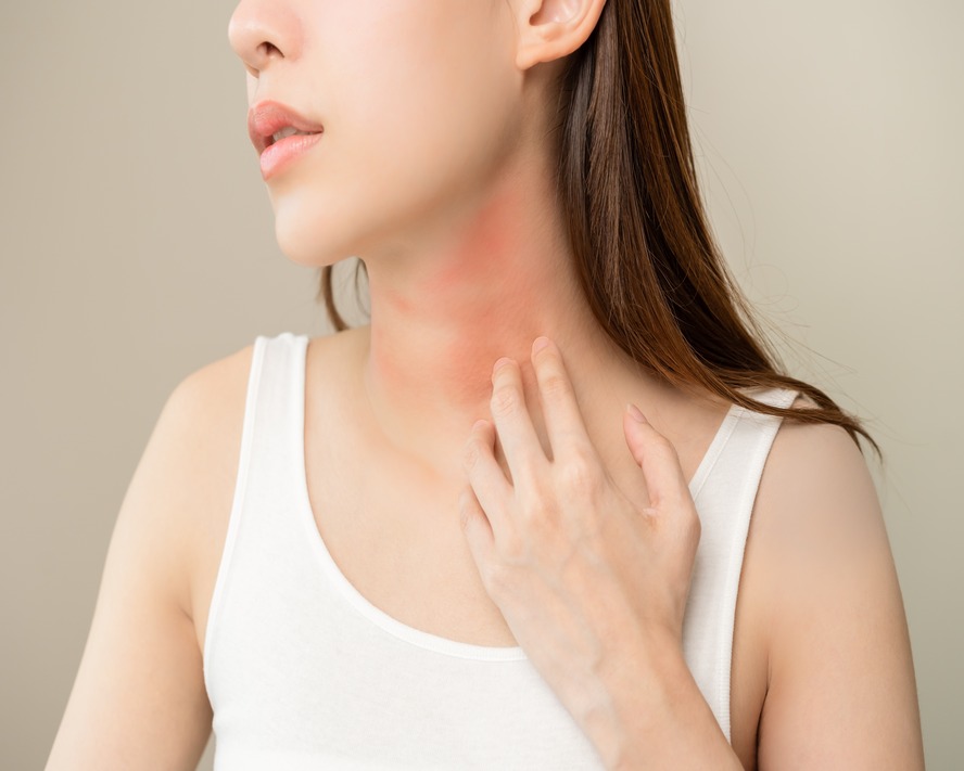 Egzama (Atopik Dermatit) Nedir? Egzama Nasıl Geçer?