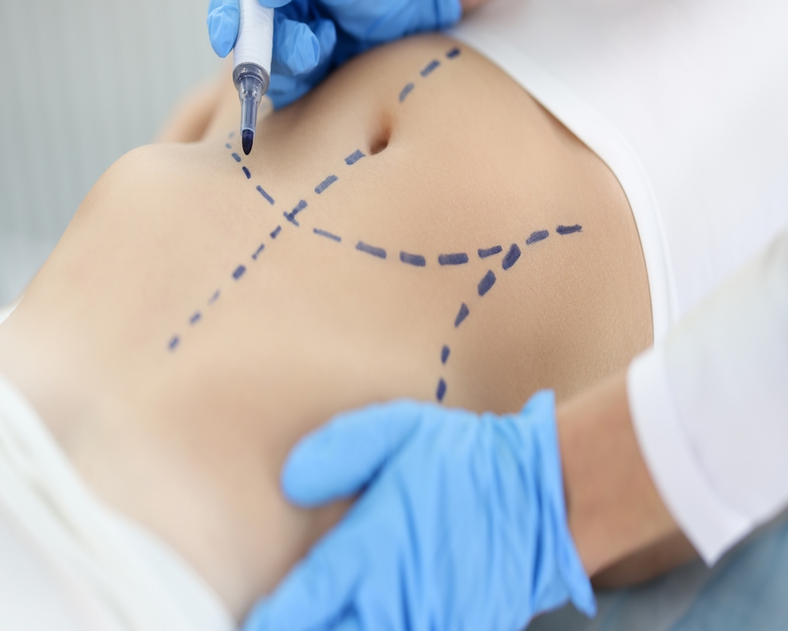 Liposuction Nedir ? Nasıl Uygulanır?