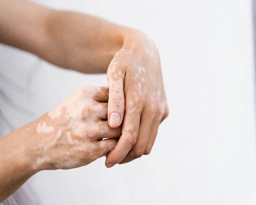 Vitiligo Nedir? Belirtileri Nelerdir?