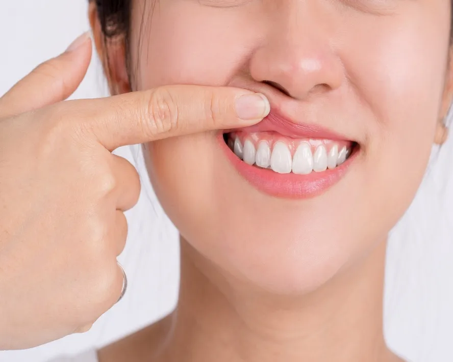 Diş Eti Çekilmesine Ne İyi Gelir? Diş Eti Çekilmesi Tedavisi Nasıl Yapılır?