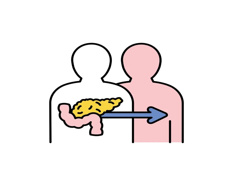 Pankreas Nakli Süreci ve Pankreas Nakli Nasıl Yapılır?