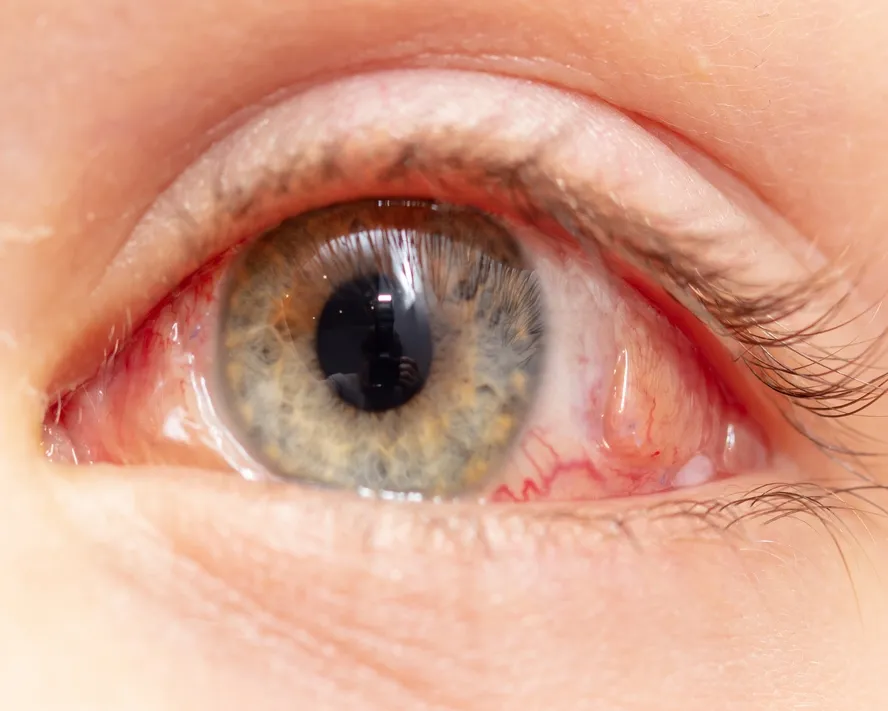 Vitrektomi Nedir? Vitrektomi Ameliyatı Hakkında Her Şey