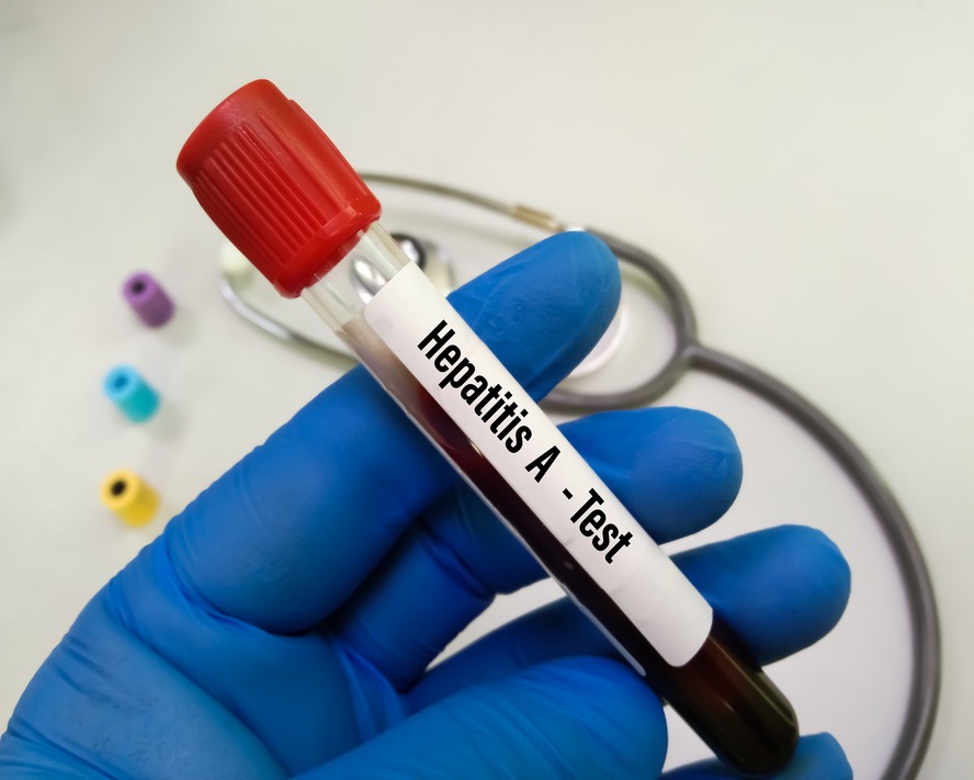 Hepatit A Nedir? Belirtileri Nelerdir?