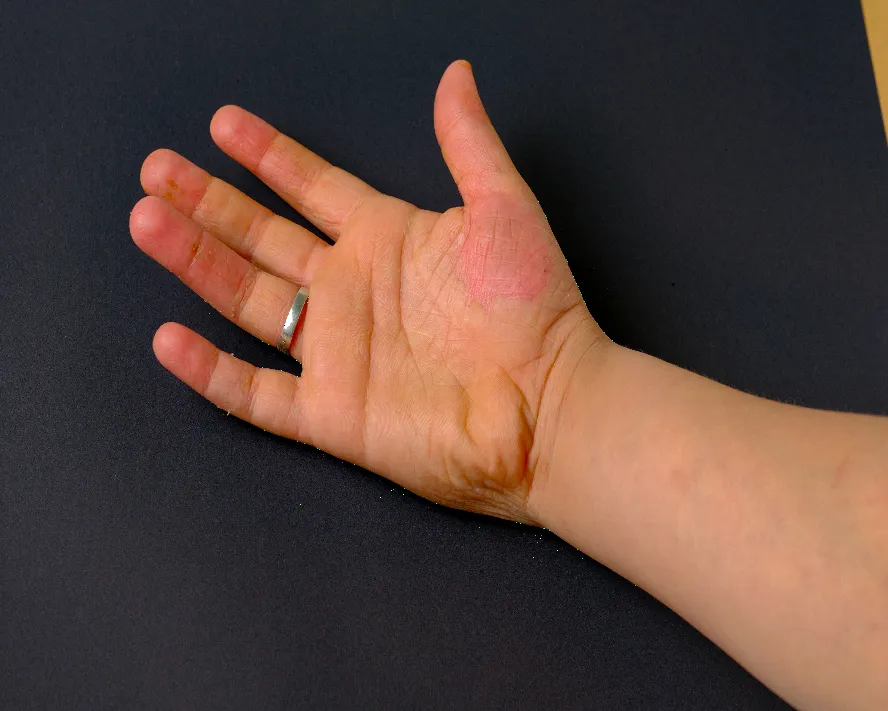 Bülloz Pemfigoid Nedir? Belirtileri ve Tedavisi