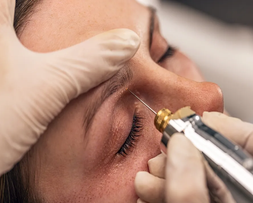 Fibroblast Nedir?