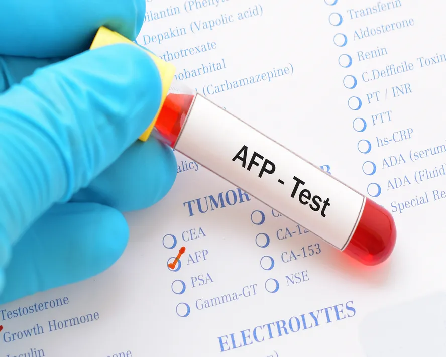 AFP Testi (Alfa FetoProtein) Nedir? Yüksekliği ve Düşüklüğü Neden Olur?