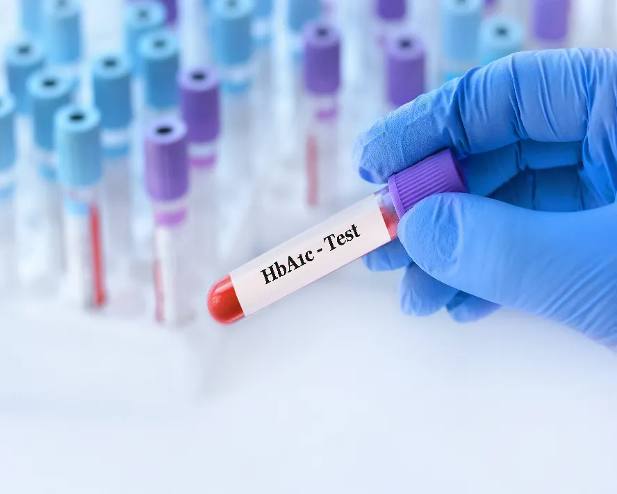 Hba1c Normal Değeri Nedir? Hba1c Testi
