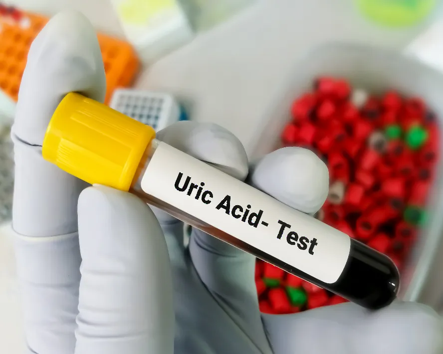 Ürik Asit Yüksekliği Nedir?