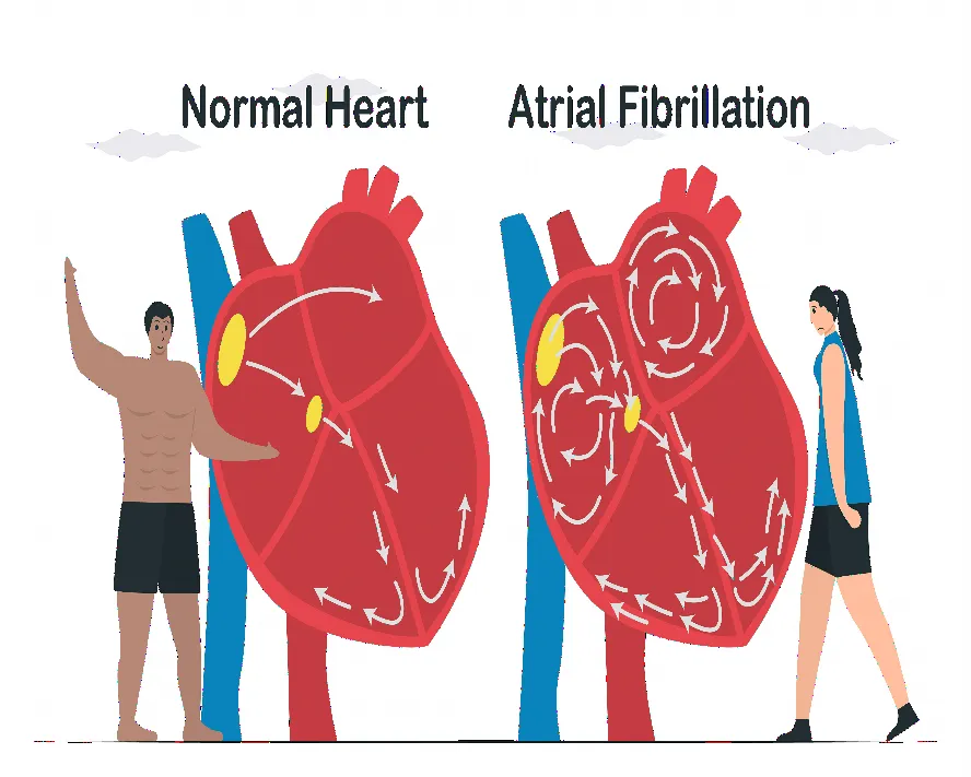 Atriyal Fibrilasyon Nedir? Nasıl Tedavi Edilir?