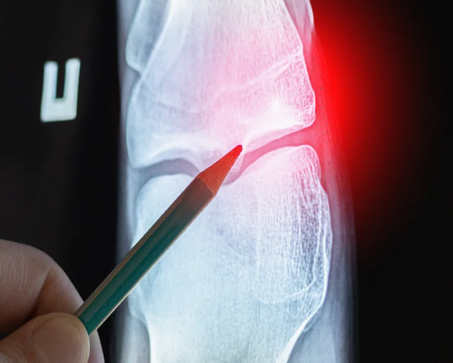 Osteoid Osteoma Tümörü Nedir? Beliritleri ve Tedavisi