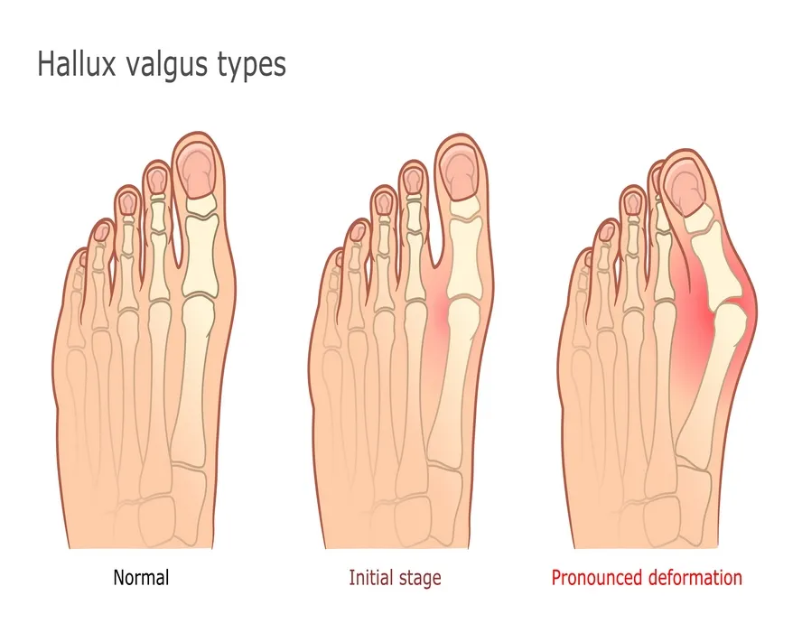 Halluks Valgus Nedir?