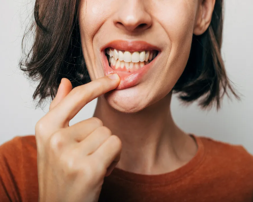 Diş Eti Kanaması Nedir? Nasıl Geçer?