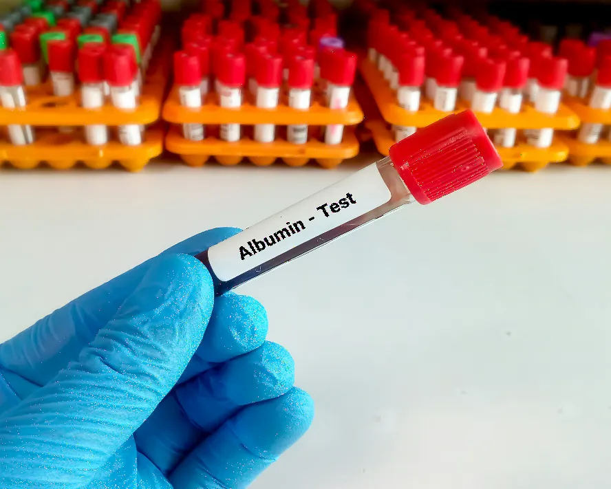 Albümin Nedir? Albümin Düşüklüğü ve Yüksekliği