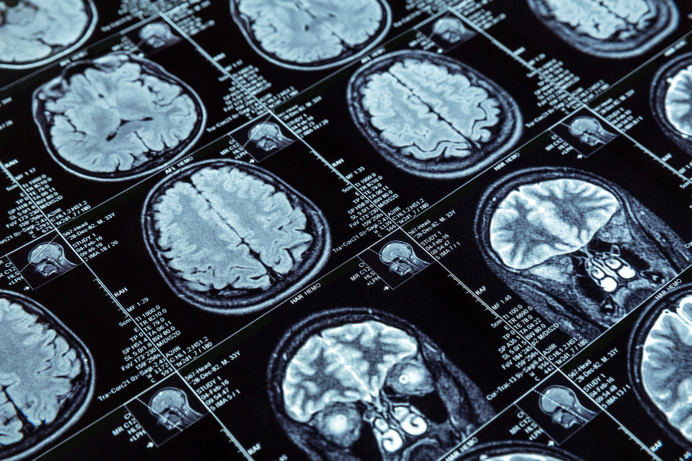 Epilepsi Cerrahisi ve Epilepsi Ameliyatı