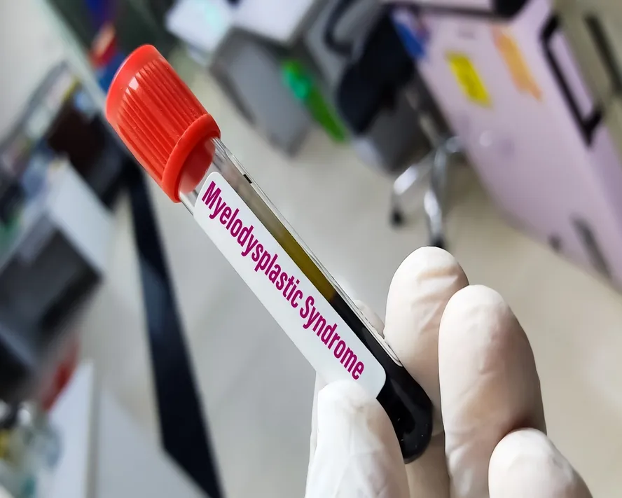 Miyelodisplastik Sendrom (MDS)