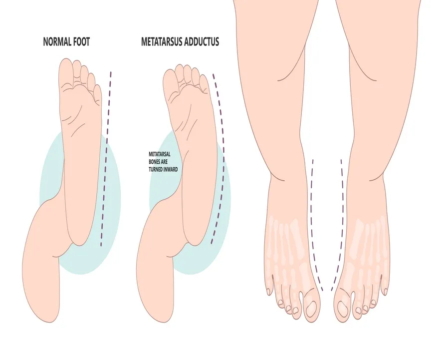 Çarpık Ayak (Pes Ekinovarus) Nedir, Tedavisi Nasıl Yapılır?