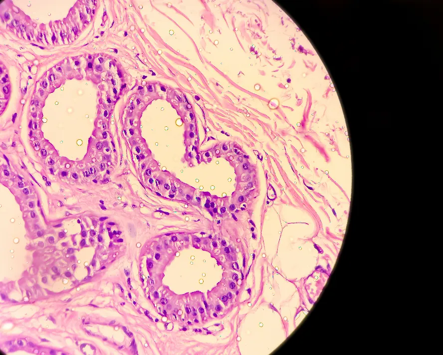 Köpek Memesi Hastalığı (Hidradenitis Suppurativa): Kapsamlı Rehber