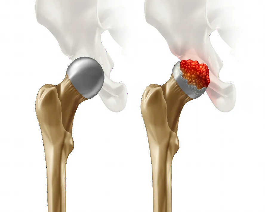 Femur Başı Avasküler Nekroz