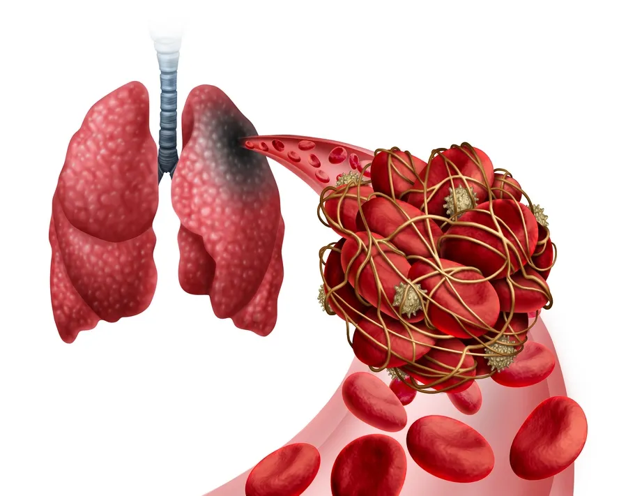 Pulmoner Emboli (Akciğer Embolisi) Nedir? Belirtileri ve Tedavisi