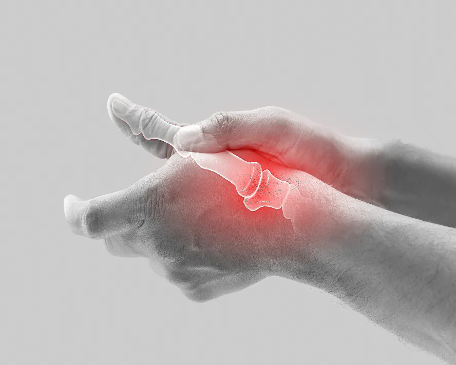Başparmak Kök Ekleminde Kireçlenme (Osteoartrit)