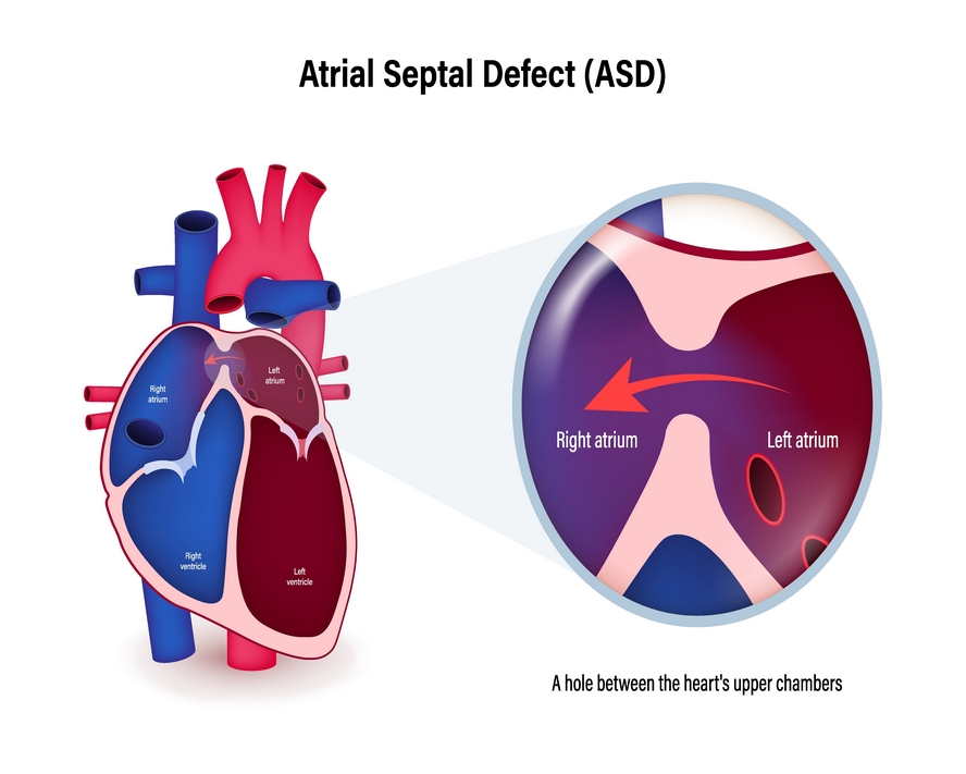 ASD (Atriyal Septal Defekt) Nedir? Belirtileri ve Tedavisi