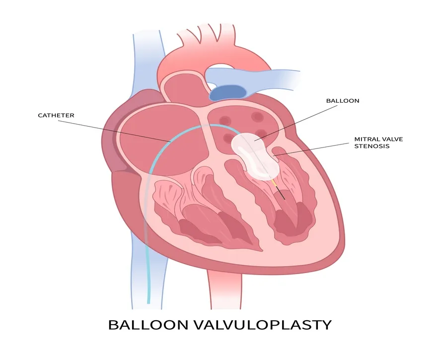 Mitral Balon Valvüloplasti Nedir?