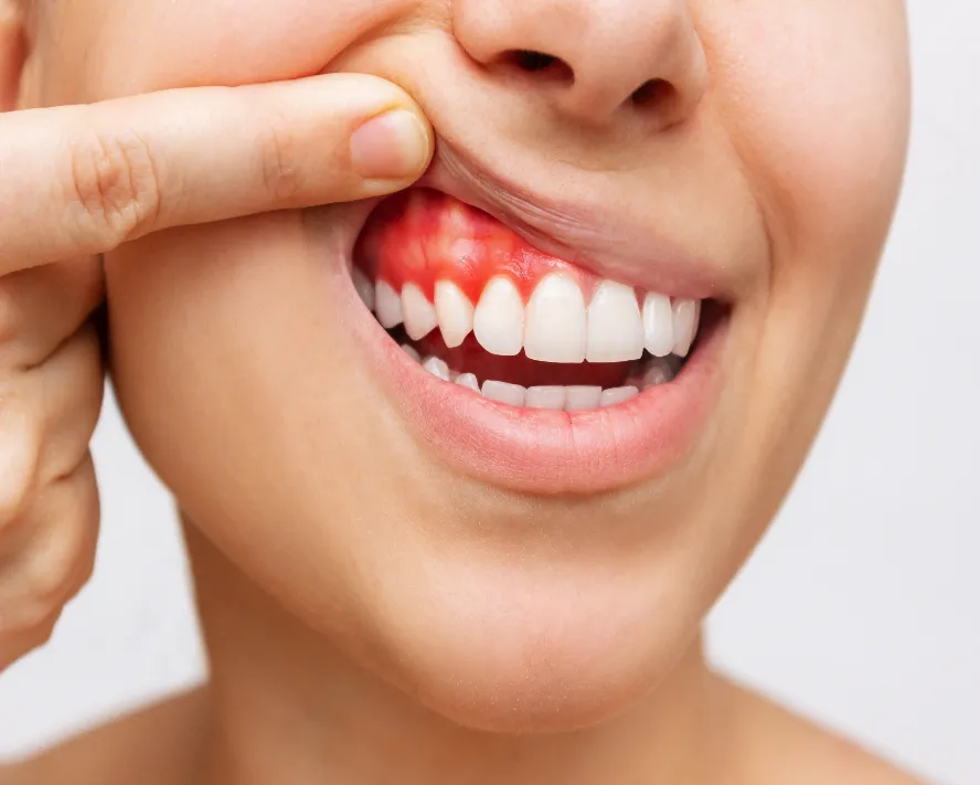 Diş Eti Hastalıkları (Periodontoloji) Nelerdir?