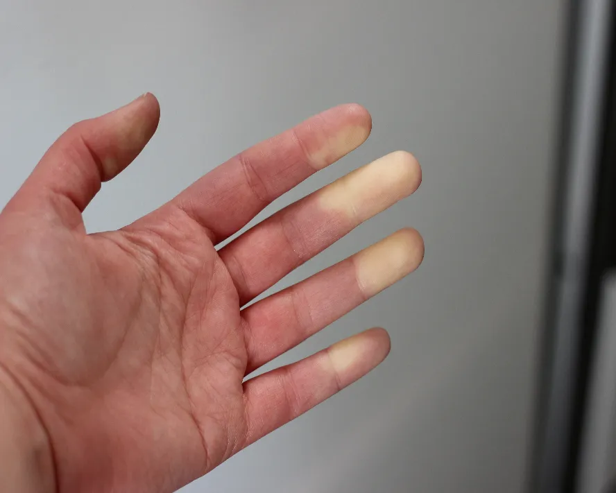 Raynaud Fenomeni Nedir?
