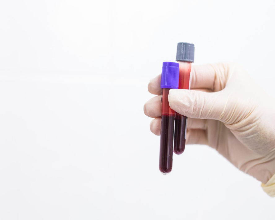Glike Hemoglobin (HbA1c) Testi: Kapsamlı Rehber