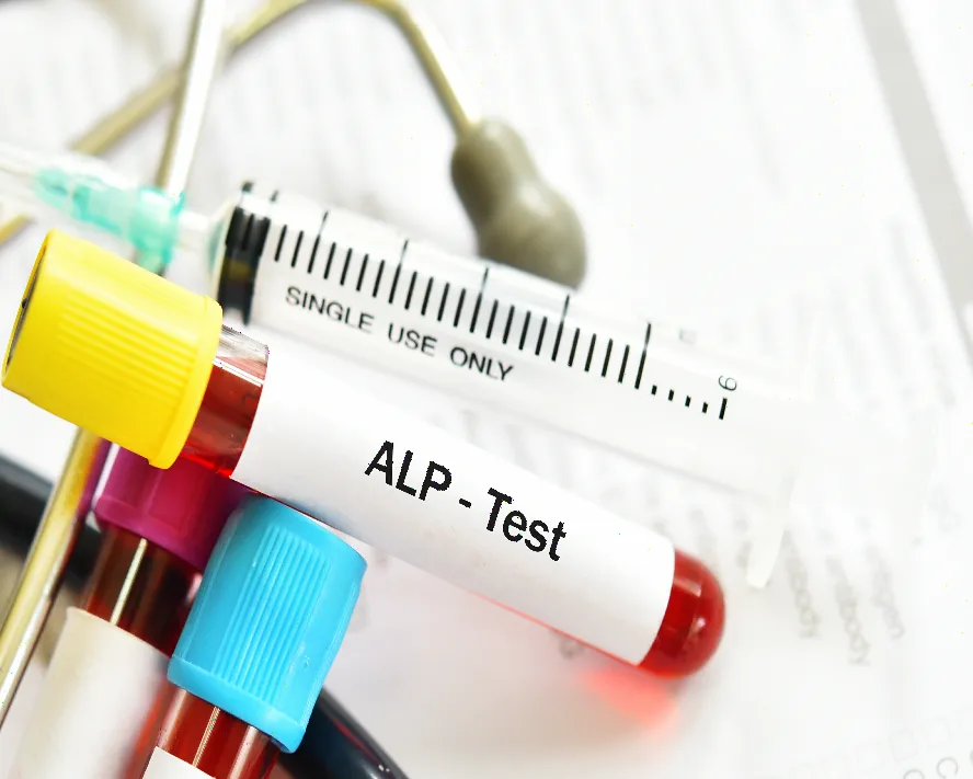 Alkalen Fosfataz (ALP) Nedir? Düşüklüğü ve Yüksekliği Nedenleri