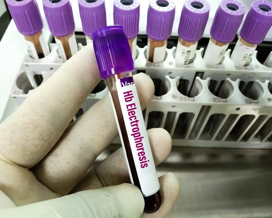 Hemoglobin Elektroforezi Testi Nedir, Neden Yapılır?&nbsp;