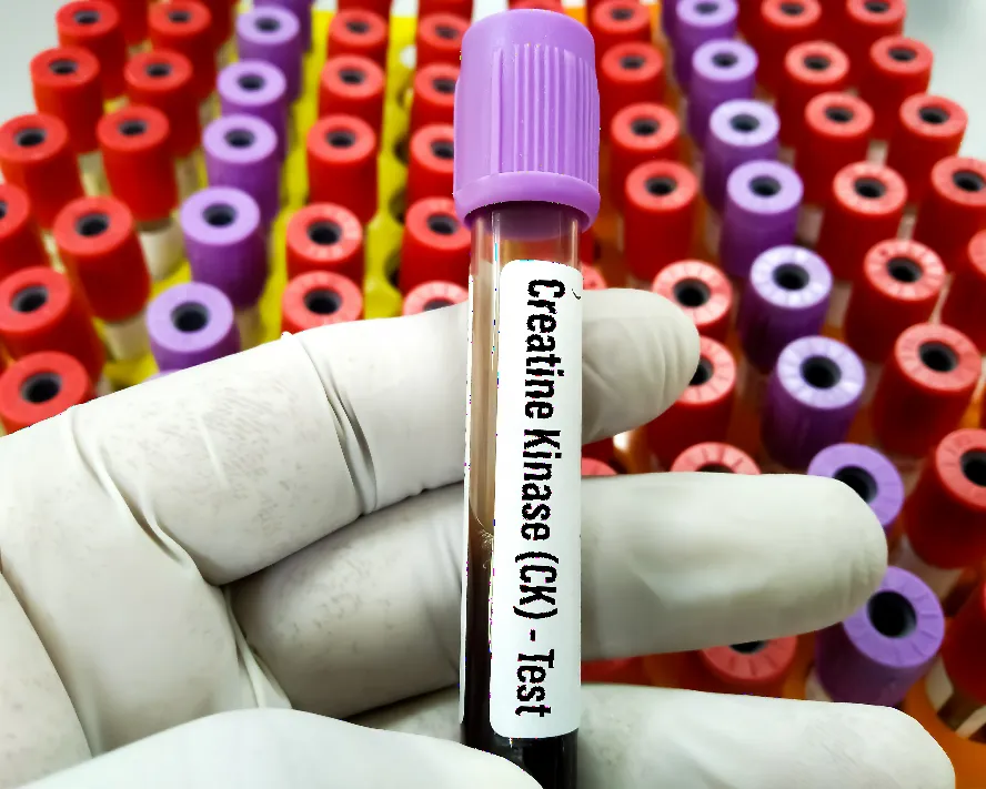 Kreatin Kinaz (Ck) Nedir? Kaç Olmalı? Düşüklüğü ve Yüksekliği Nedenleri